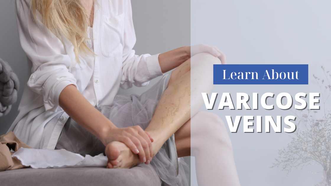 What are Varicose Veins?