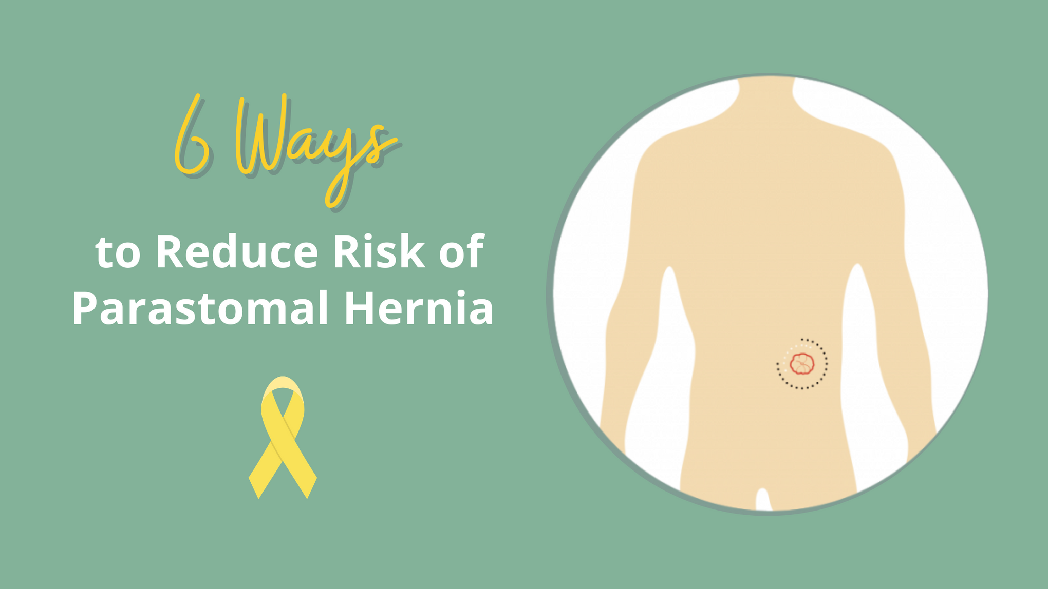 6 Ways to Reduce Risk of Parastomal Hernia_Ostomy_Nightingale Medical Supplies